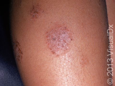 Nummular Dermatitis Condition, Treatments and Pictures for Teens - Skinsight