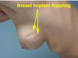 What Causes Rippling In Breast Implants? | Dr. Brucker